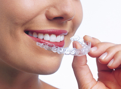 Behandlung Ästhetische Korrektur mit transparenten Schienen (Invisalign/Clear-Aligner) | Kieferorthopädische Fachzahnarztpraxis Dr. Schaurer in Mannheim